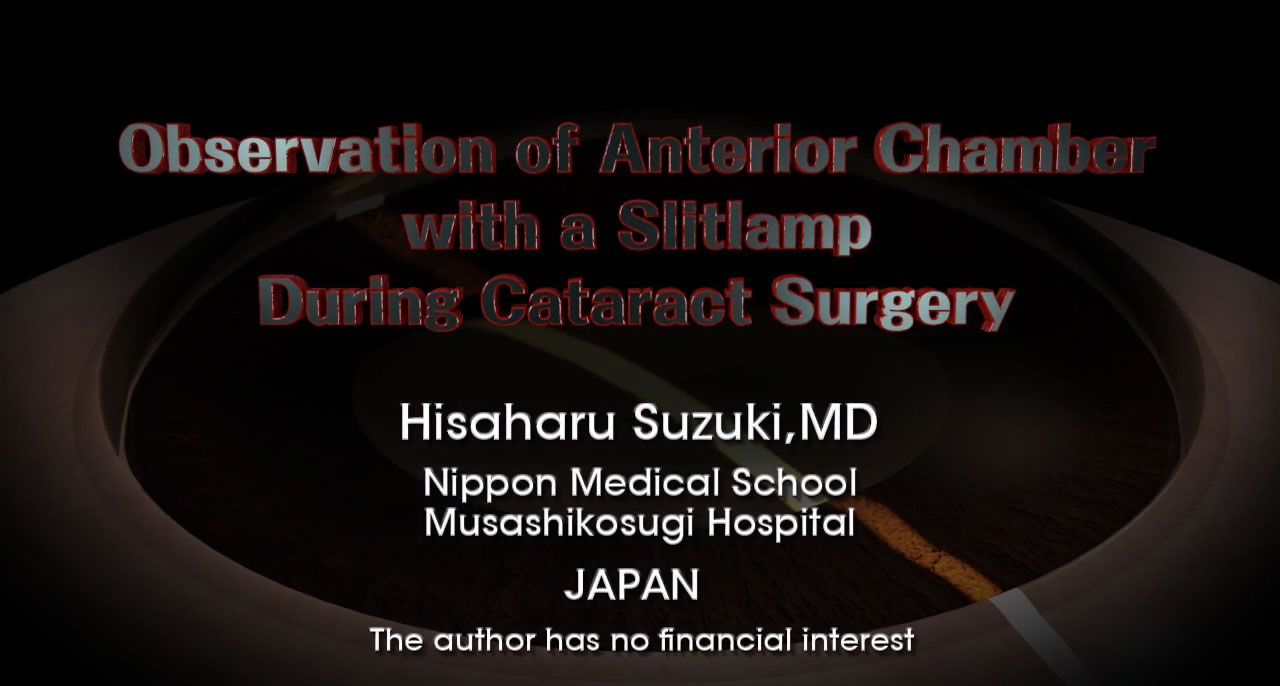 Observation of Anterior Chamber with a Slitlamp During Cataract Surgery