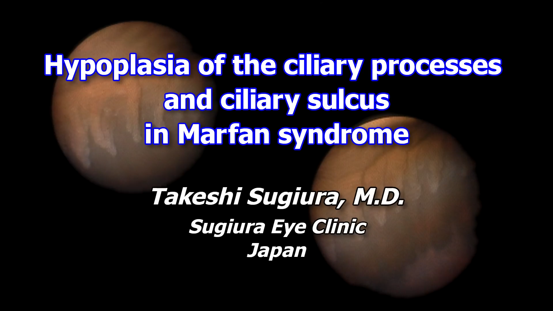 Hypoplasia of the ciliary processes and ciliary sulcus in marfan syndrome