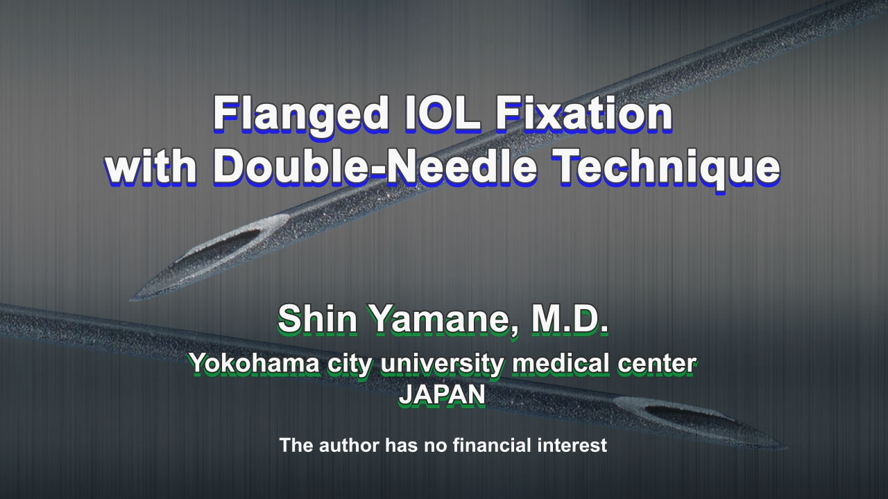 Flanged IOL Fixation with Double-Needle Technique
