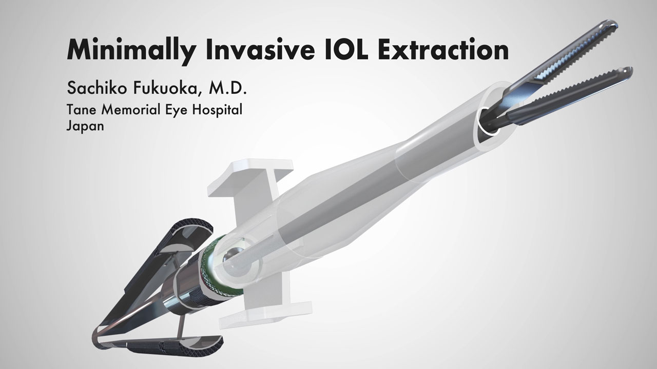 Minimally Invasive IOL Extraction | WORKS | video studio NEXT ビデオ企画・制作・編集・撮影